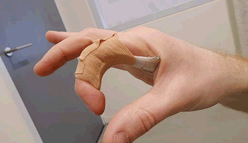 Genezen pijnlijke vinger muzikant musici-overbelasting oefeningen